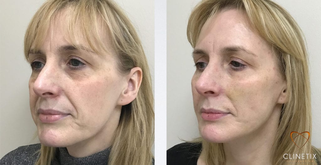 The Thread Lift Rejuvenation Glasgow