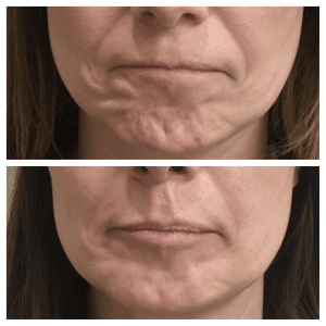 Anti wrinkle injections in the chin by Dr Ravichandran at Clinetix Glasgow to improve the appearance of dimpling and roughened skin over the chin.