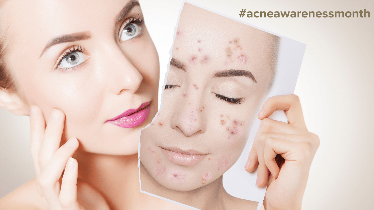 Topical Treatments for Acne