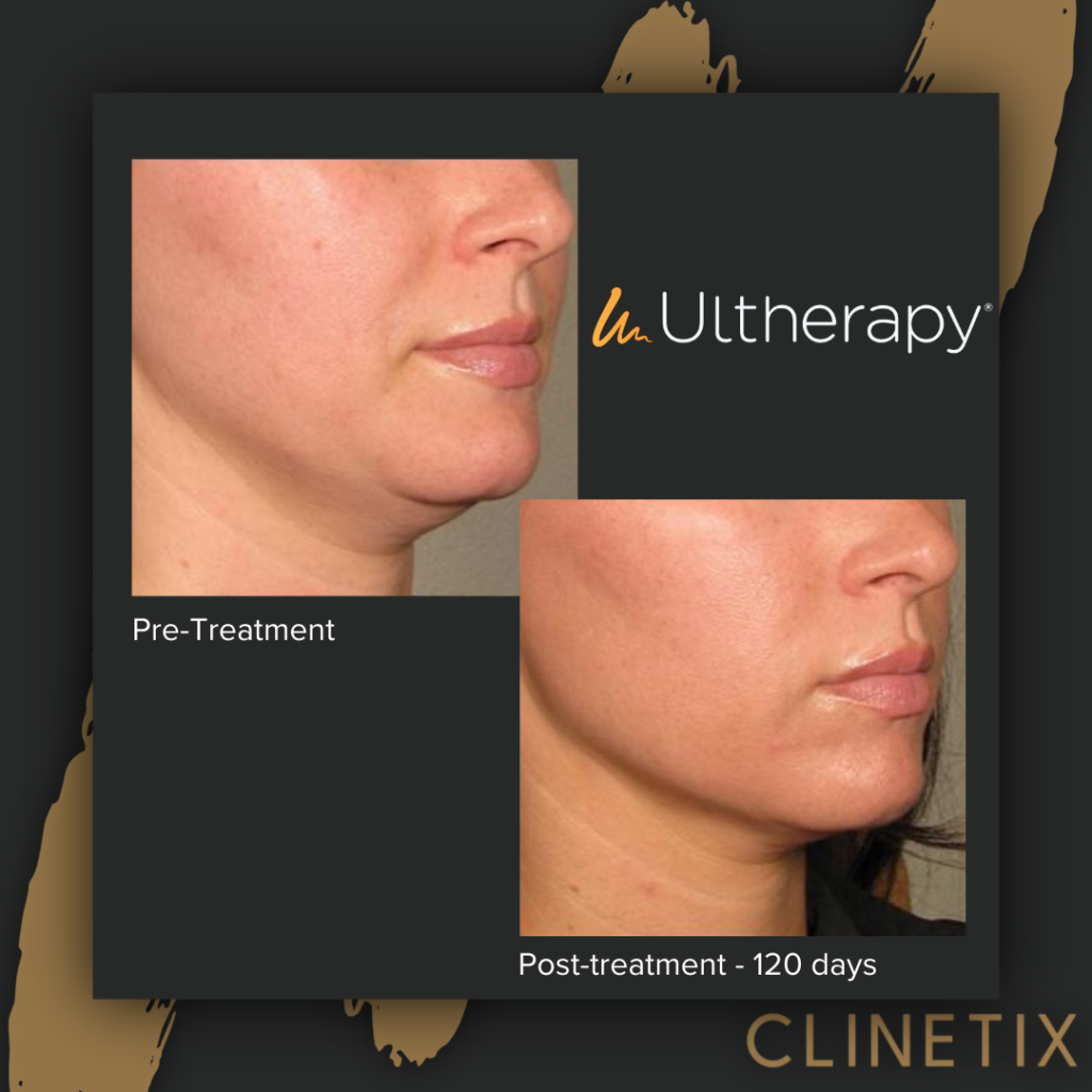 What does Ultherapy do?